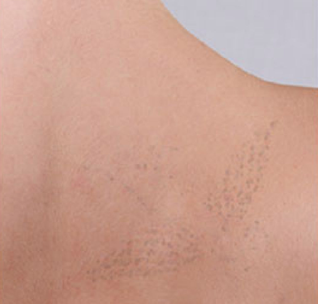 Tatoo removal after