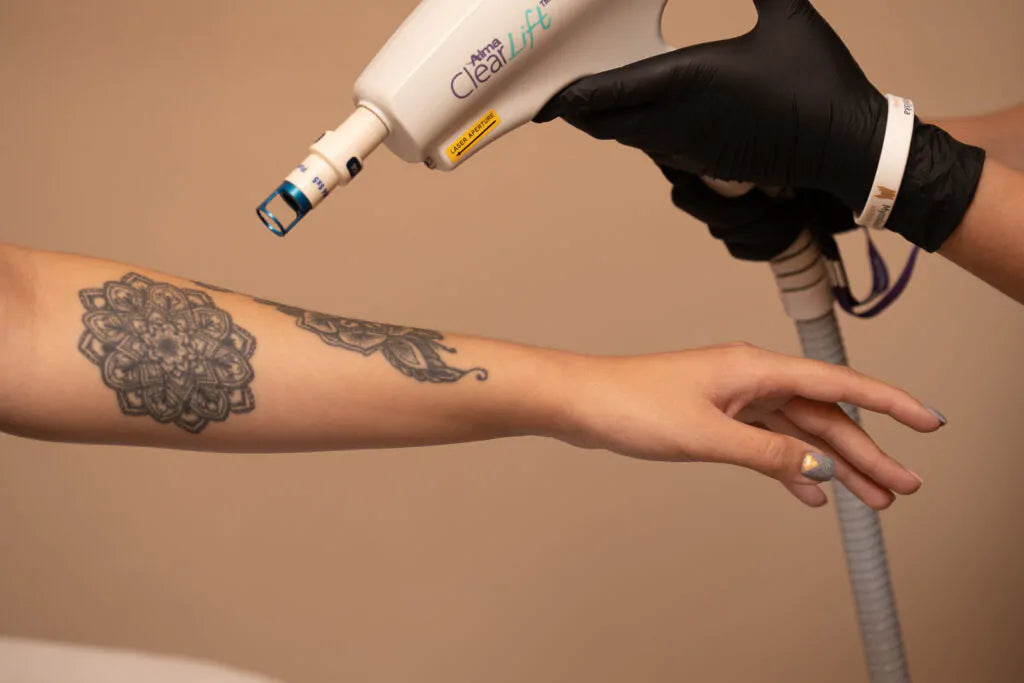 tatoo removal